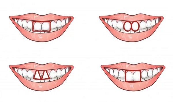 Xem tướng răng của phụ nữ